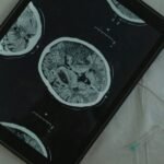 Close-up view of a brain CT scan displayed on a digital tablet with a medical needle beside it.